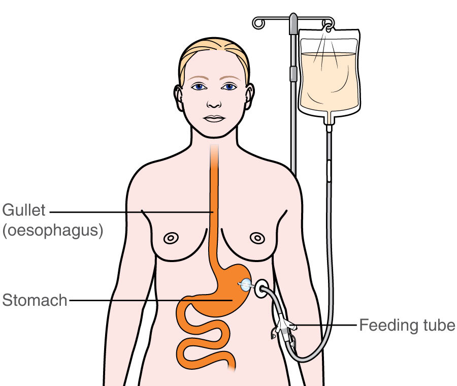 Perawathomecare Prosedur Percutaneous Endoscopic Gastrostomy Perawathomecare Prosedur Percutaneous Endoscopic Gastrostomy