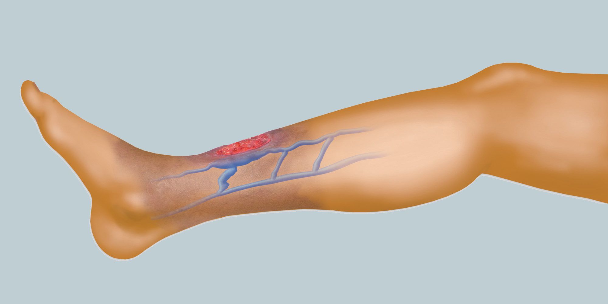 Panduan Teknis Medis Rumahan: Prosedur Aman & Standar Medis Pencegahan Perparahan Luka Diabetes di Layanan Homecare